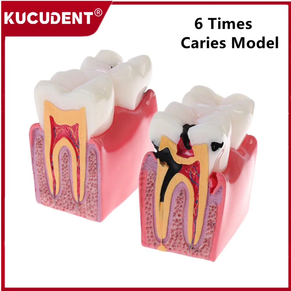 6 Times Caries Comparison Dental Teeth Model Study Denture Tooth Models Dentist Comparation Demonstration Anatomy Student Teach