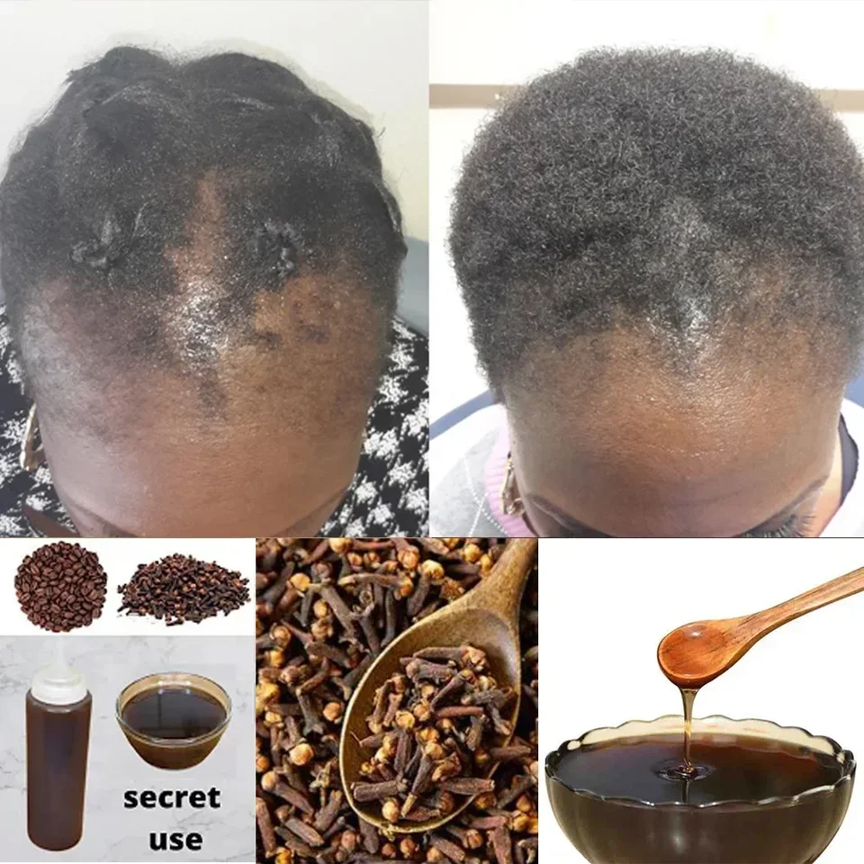 Africké ženy Trakčné alopécie Liečba vypadávania vlasov Zbavte sa parochne Produkt Hair Rast Produkt pre mužov Šampón 300 ml starostlivosti o vlasy
