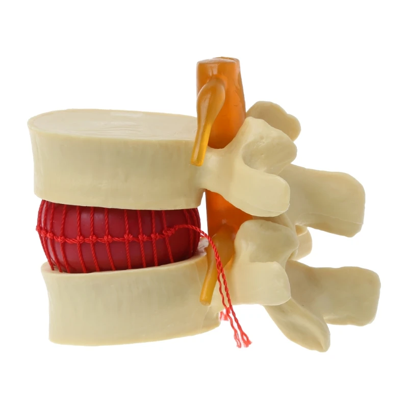 Anatomická chrbtica bedrová disk hernia