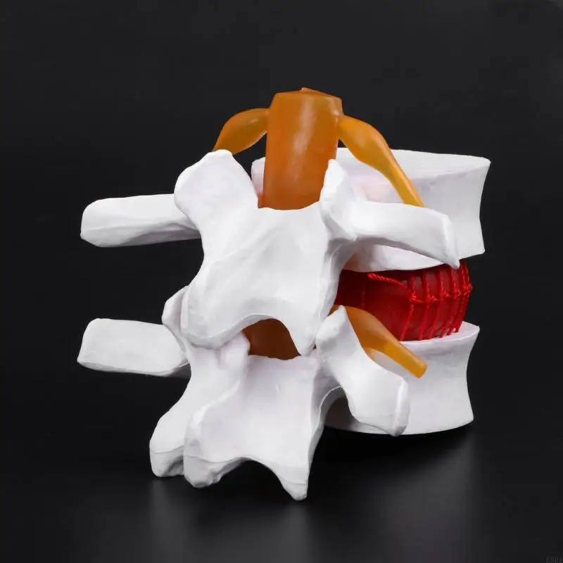 E8be Human Anatomical Lumbbar Disc Herniay Model Medical LeAct And Anatomia Instrume