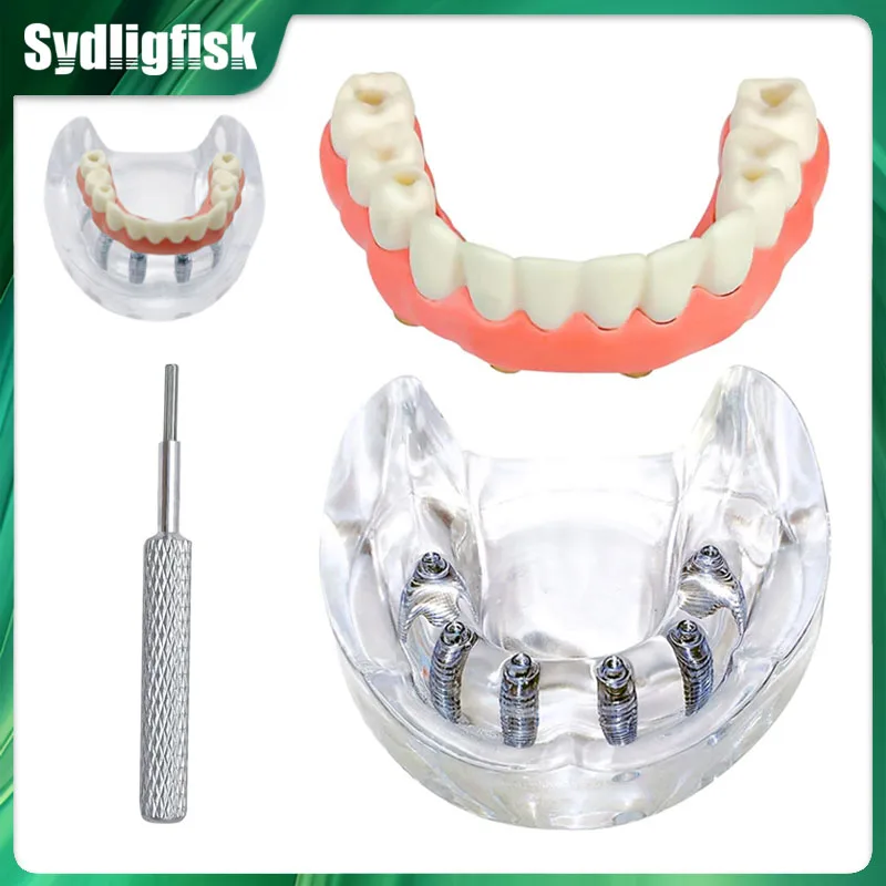 Model zubov zubov zubov Model 6 implantát preddávky obnovy zubov zubné zubné zubné vzdelávanie Typodont implantát Model