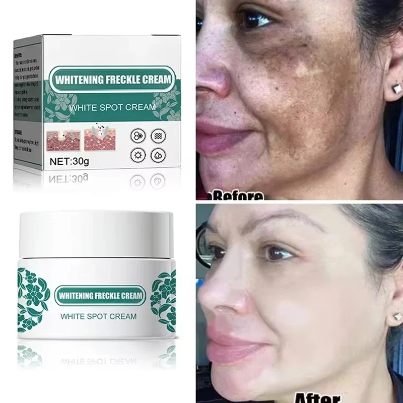 Niacinamid Melasma Blering Cream Znížte melanín odľahčenie tmavej pokožky Chloasma Sérum Zmizne jemné línie tvárou v tvár Kórejské starostlivosť