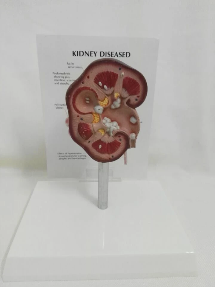 Patologický obličkový anatomický model obličky Anatómia výučba pomoci chorú obličky
