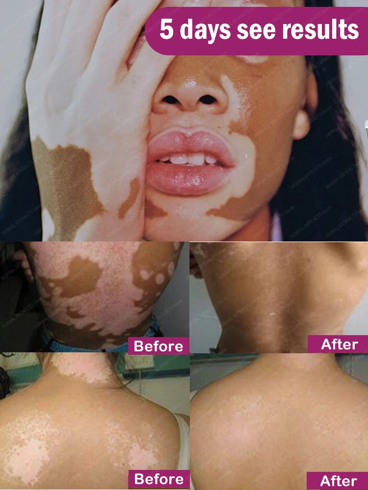 Vitiligo ošetrenie krém na melanín rastú masť rýchlo odstráňte bielu farbu