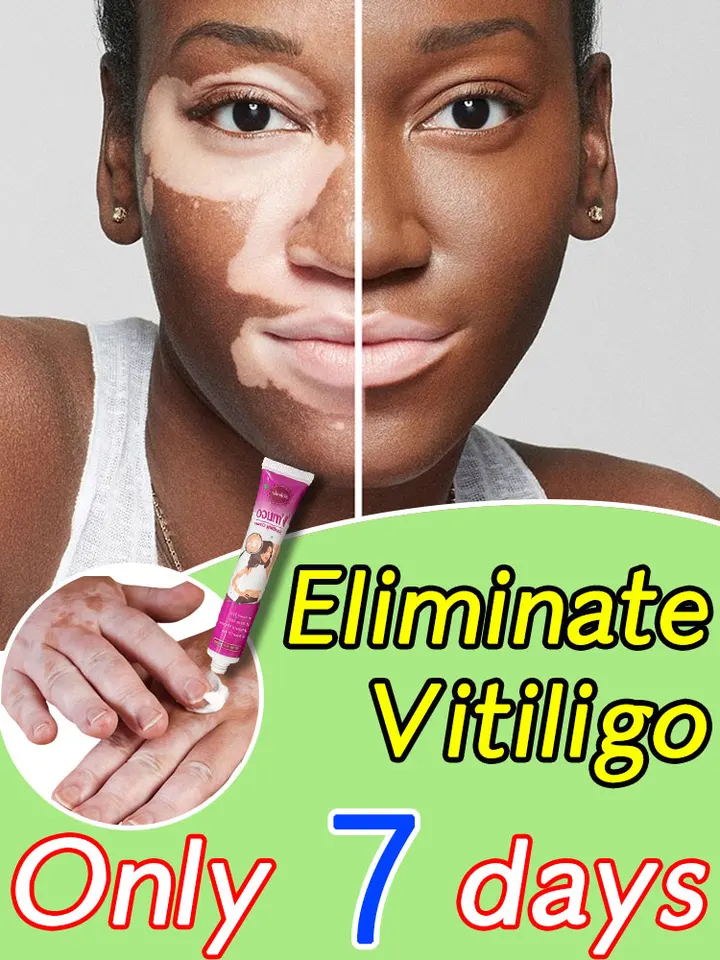 Vitiligo rýchlo zlepšuje biele škvrny