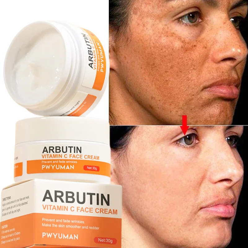 Výkonný biely krém na pehy rýchlo odstrániť melasma melanín korektor anti-pigmentácia tmavá škvrna Zblednutie Zlepšenie starostlivosti o pleť